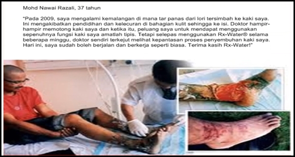 kaki terkena minyak panas