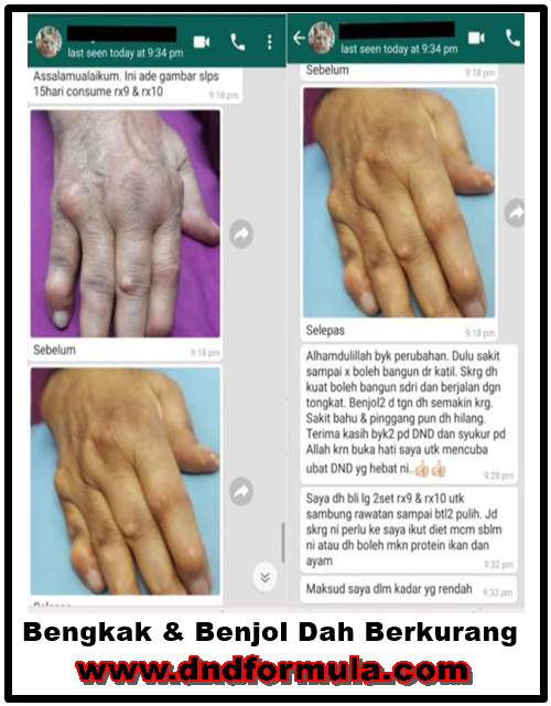 gout-bengkak n benjol dah berkurang